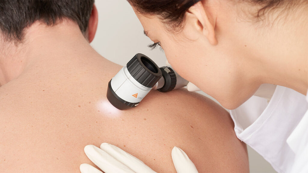 Examen dermatologique avec dermatoscope sur la peau du dos.